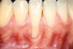 Gingival recession