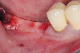 distal mandibular edentulous ridge requiring implant placement