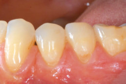 Pre-operative Baseline