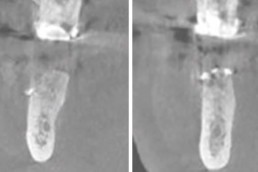 dental regeneration with hyadent bg