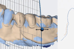 post-op dental surgery with hyadent bg