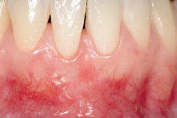 dental regeneration with hyadent bg