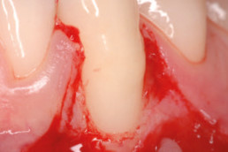 recession was treated surgically with hyadent bg