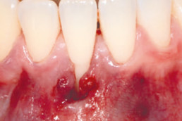 Gingival recession