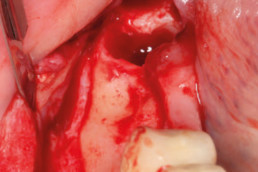 Edentulous ridge with significant loss of height and width