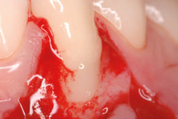 Surgical-grade xHyA gel was applied on to the root surface
