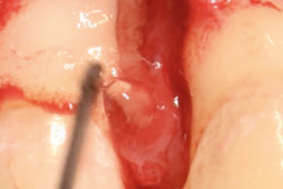 infrabony defect filled with cross-linked hyaluronic acid, hyadent bg