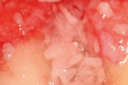 cross-linked hyaluronic acid mixed with bone filler