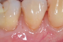 dental regeneration with hyadent bg