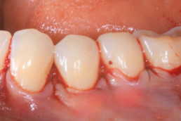 oral surgery with hyadent bg