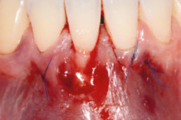 dental surgery with hyadent bg