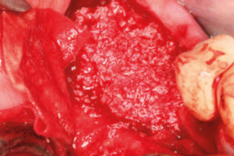 sticky bone of xenograft and hyaluronic acid gel, hyadent BG