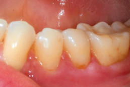 soft tissue regeneration in oral surgery with hyadent bg