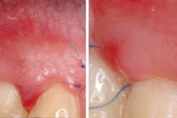 accelerated healing after dental surgery with hyadent bg