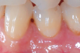 dental regeneration with hyadent bg