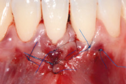 dental surgery with xHyA gel on laterally closed tunnel