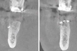 dental regeneration with hyadent bg