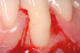 recession was treated surgically with hyadent bg