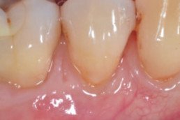 dental regeneration with hyadent bg