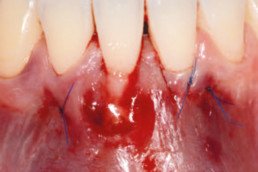 dental surgery with hyadent bg