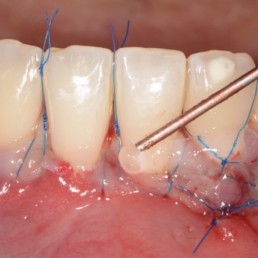 Application of hyadent BG on gingival recession by Prof Anton Sculean